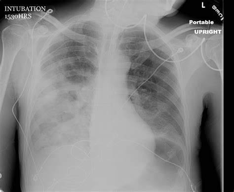 Diagram Diagram Pneumonia X Ray Mydiagramonline