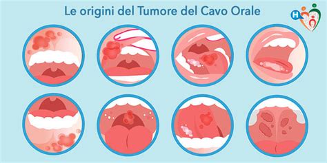 Tumore Del Cavo Orale Cause Diagnosi E Trattamento