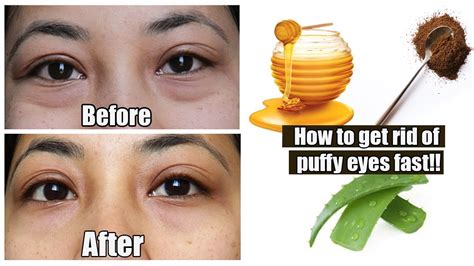 How To Reduce Puffy Eyes In 15 Minutes Home Remedies Youtube