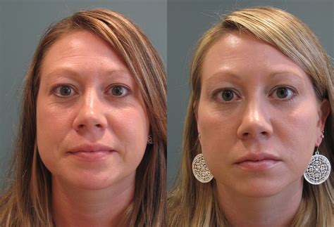 Botox Before And After Savannah Facial Plastic Surgery