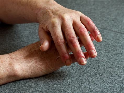Arthritis In Fingers What Does It Feel Like Causes And Treatment 2022