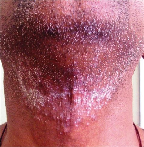 Pseudo Conditions In Dermatology Need To Know Both Real And Unreal