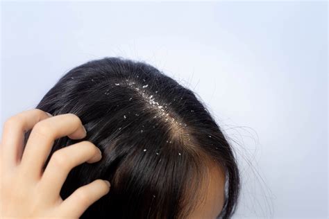 Details More Than 124 Why Dandruff Occurs In Hair Vn