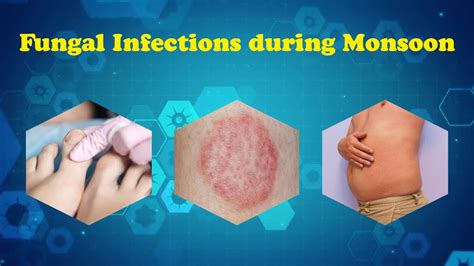 Fungal Infections During Monsoon Types Of Fungal Infections