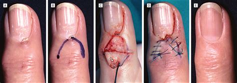 Skin Excision And Osteophyte Removal Is Not Required In The Surgical