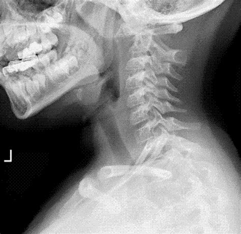 Lateral Cervical Radiograph Showing Anterior Subluxation Of C 1 On C 2