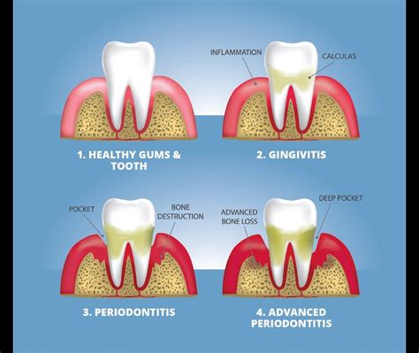 3 Easy Facts About Tips For Healthy Teeth And Gums Sensodyne Shown