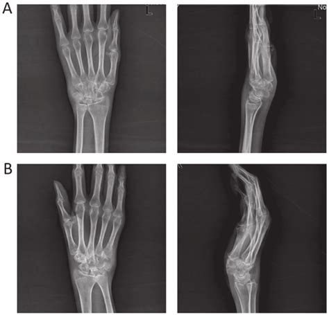 Joint X Rays Of A Left And B Right Wrists Download Scientific