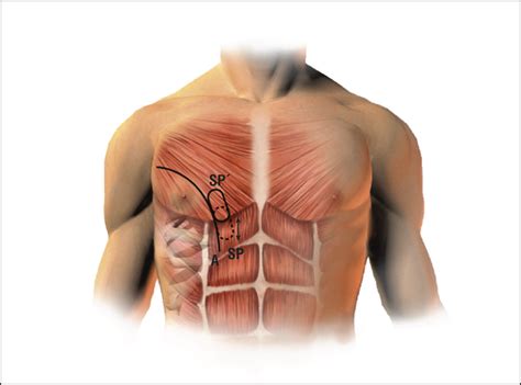 Improved Skin Paddle Survival in Pectoralis Major Myocutaneous Flap