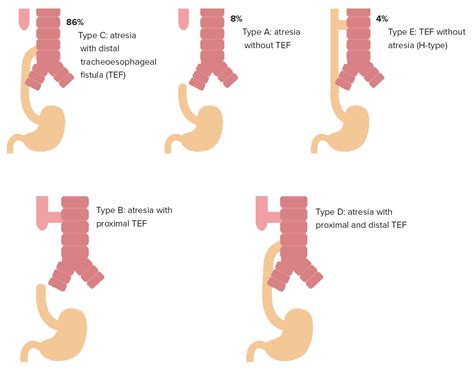 Esophageal Atresia Types Set Congenital Medical Condition Of Trachea