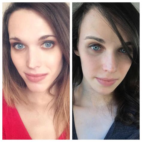 6 Years Hrt Left Is Pre Ffs Right Is About 3 Months Post Op Ffs