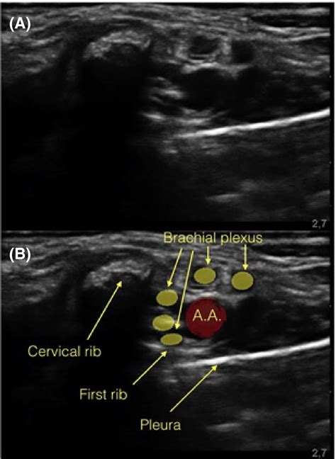 Supraclavicular Approach Of Brachial Plexus A The Ultrasound Image Of
