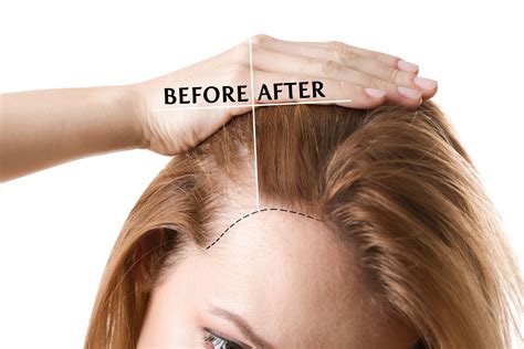 Details More Than 74 Hair Growth On Forehead Female Super Hot In