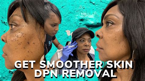 Dpn Removal For Smoother Skin Youtube