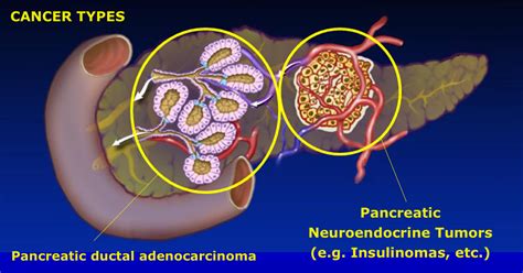 Pancreatic cancer can form in exocrine cells and neuroendocrine cells. Staging - Hirshberg Foundation for Pancreatic Cancer Research