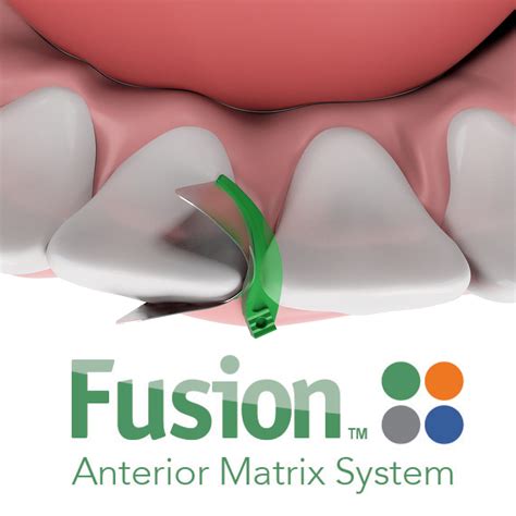 Garrison Introduces The New Fusion Anterior Matrix System Dental Asia