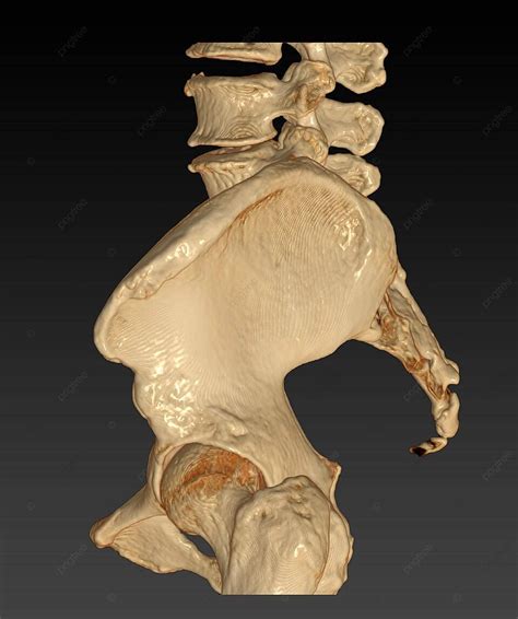 Threedimensional Rendering Of Lateral View Ct Scan Of Pelvic Bone With