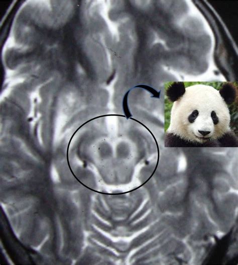 Face of the giant panda | Eurorad