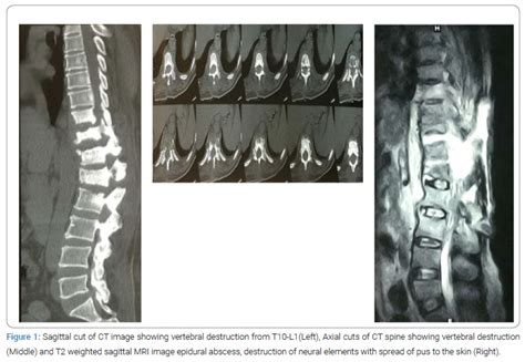 Post Operative Invasive Spinal Aspergillosis Causing Paraplegia In