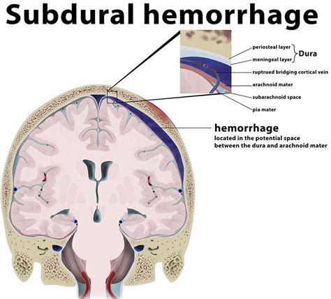 What Is Subdural Hematoma Subdural Hematoma Epidural Hematoma Images