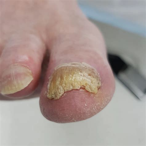 Thick Toenails Cause Symptoms And Treatment