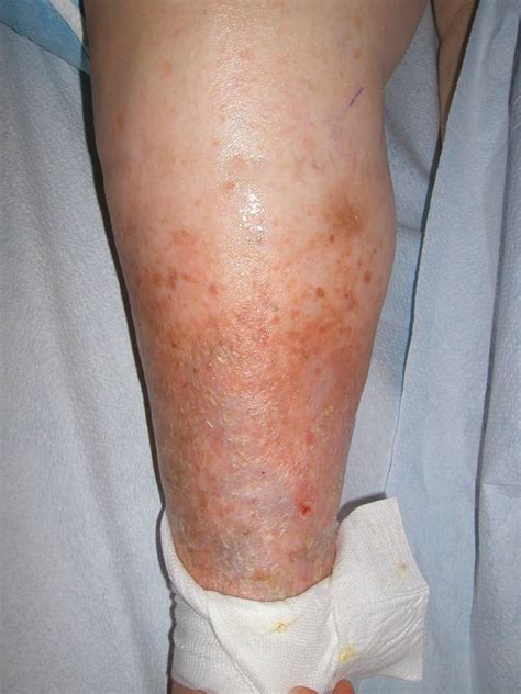 Patient 2 Elderly Woman Before Treatment She Has Severe Leg Swelling