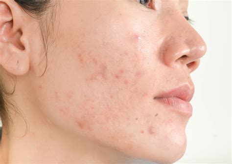 Natural Ways To Treat Acne
