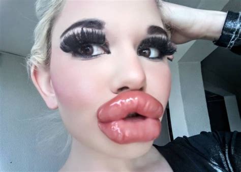 Bulgarian Woman Addicted To Lip Fillers Quadruples The Size Of Her