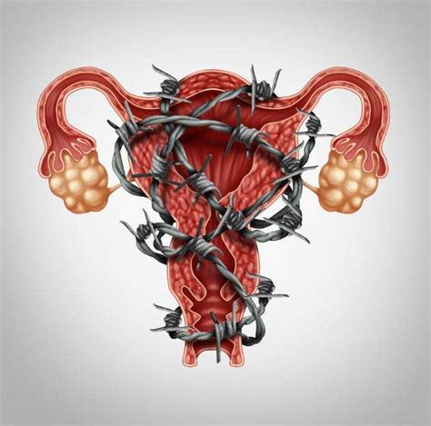 Mitos Y Verdades Sobre La Endometriosis Ivi