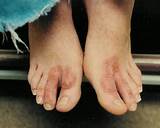 Photos of Shoe Contact Dermatitis Treatment