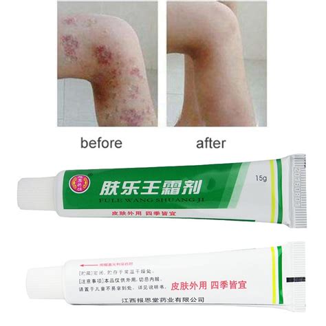1pc Skin Psoriasis Cream Dermatitis Eczematoid Eczema Ointment