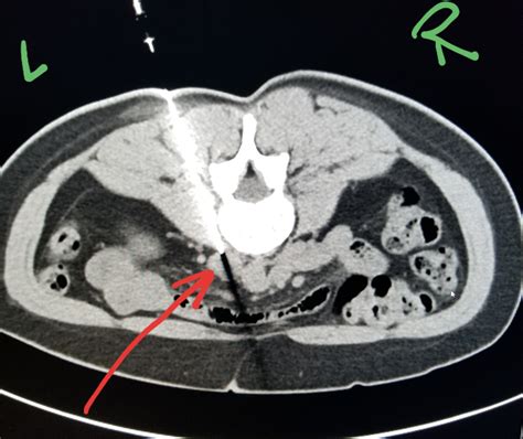 Abdomen Ct Biopsy Of A Lymph Node Adjacent To The Aorta