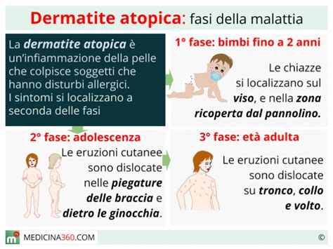 Dermatite Atopica Cause Sintomi Cure E Rimedi Naturali My Xxx Hot Girl