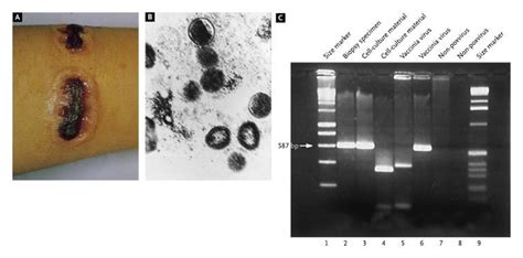 Cowpox Infection — NEJM