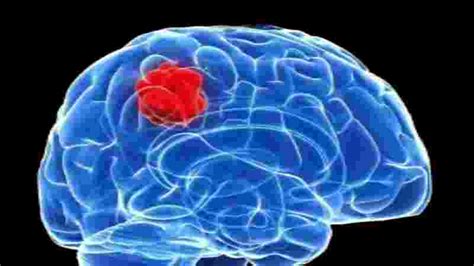 Israeli Scientists Discover Way To Block Spread Of Brain Cancer
