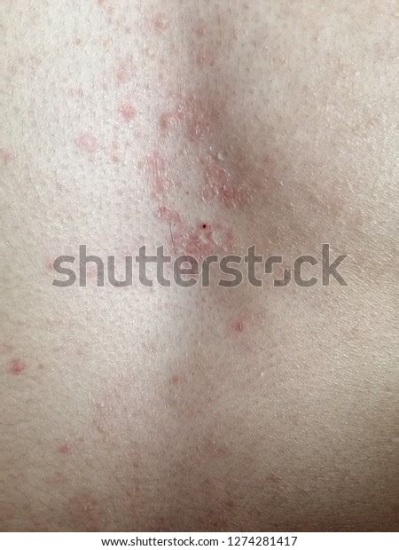 Pityriasis Rosea Type Dermatitis Mild Pink 스톡 사진 1274281417 Shutterstock