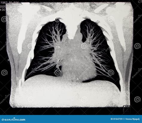 Chest Computed Tomography Stock Image Image Of Iodine 8164759