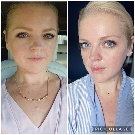 Juvederm lip fillers. Before and after. Second time after 6 months. 1 ...