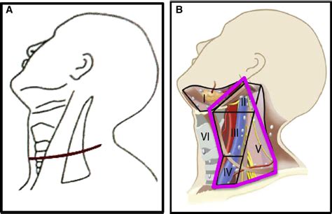 Figure 1 From Pattern Of Neck Recurrence After Lateral Neck Dissection