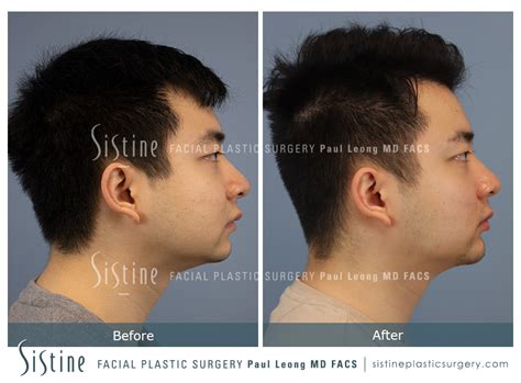 Jawline Slimming Before And After 01 Sistine Facial Plastic Surgery