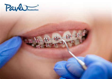 How To Handle Orthodontic Emergencies Pavlo Orthodontics