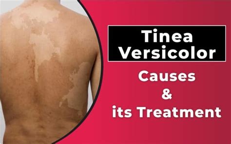 Tinea Versicolor Causes And Its Treatment Sakhiya Skin Clinic