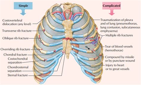 Thoracic Cage Injuries Simple And Complicated ~ Medicine Hack