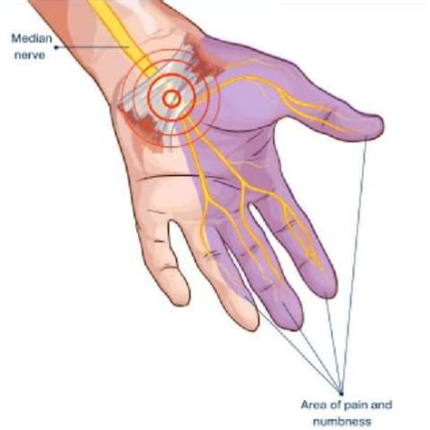 Physical Therapy For Hand And Wrist Glendale AZ Hand Physical Therapy