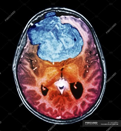 Coloured Computed Tomography Ct Scan Of The Brain Of A 25 Year Old Patient With A Meningioma