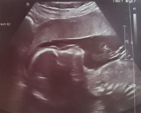 ultraschallbilder mehr als 50 bilder aus der schwangerschaft faminino
