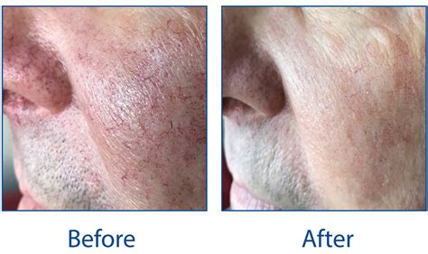 Facial Thread Vein Treatment Ipl Beauty Skin Non Surgical Clinic