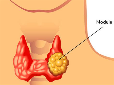 Thyroid Conditions Brisbane Gold Coast — Dr Terence Chua · General Surgeon And Colorectal Surgeon