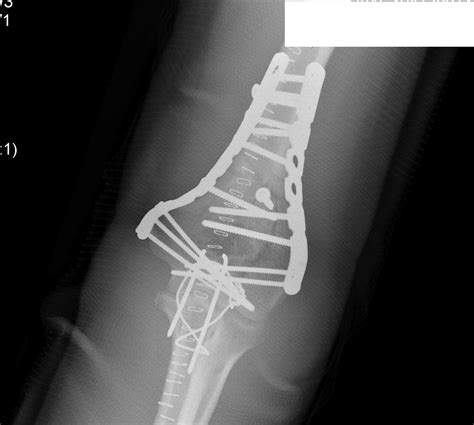 Upper Limb