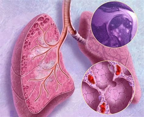 It usually occurs in the lungs and lymph nodes, but it can occur in almost any organ. Sarcoidosis Diagnostic Score Enhances Disease Diagnosis ...